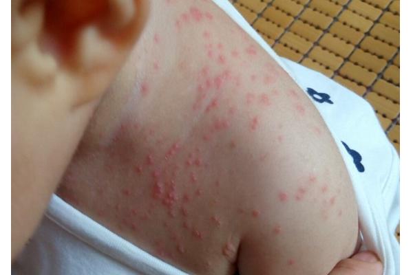 宝宝身上起小红点怎么处理,宝宝身上有小红点是怎么了还痒