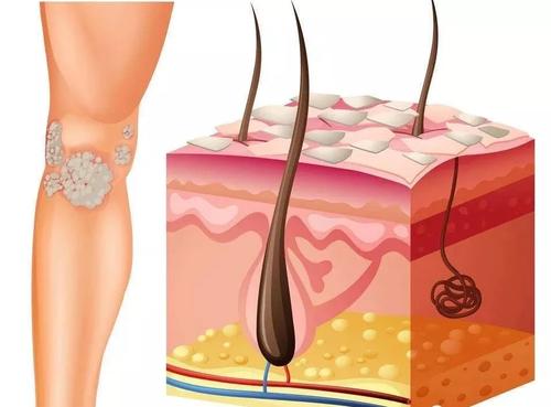 青岛皮肤癣的新疗法,淄川牛皮癣的治疗方法