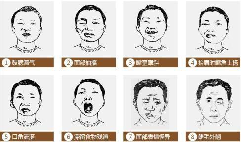 面瘫治疗在线咨询,发现有面瘫的前兆要去医院吗