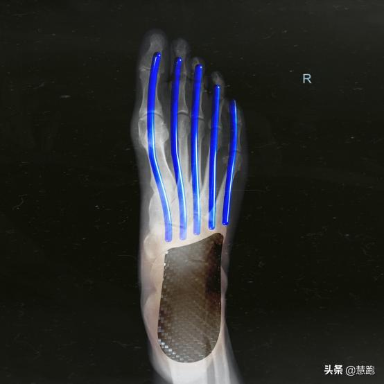 跑鞋全掌碳板和半掌碳板的区别,什么跑鞋最好有碳板