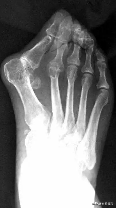 詹姆斯脚踝外翻对他的影响,詹姆斯的脚趾到底怎么回事