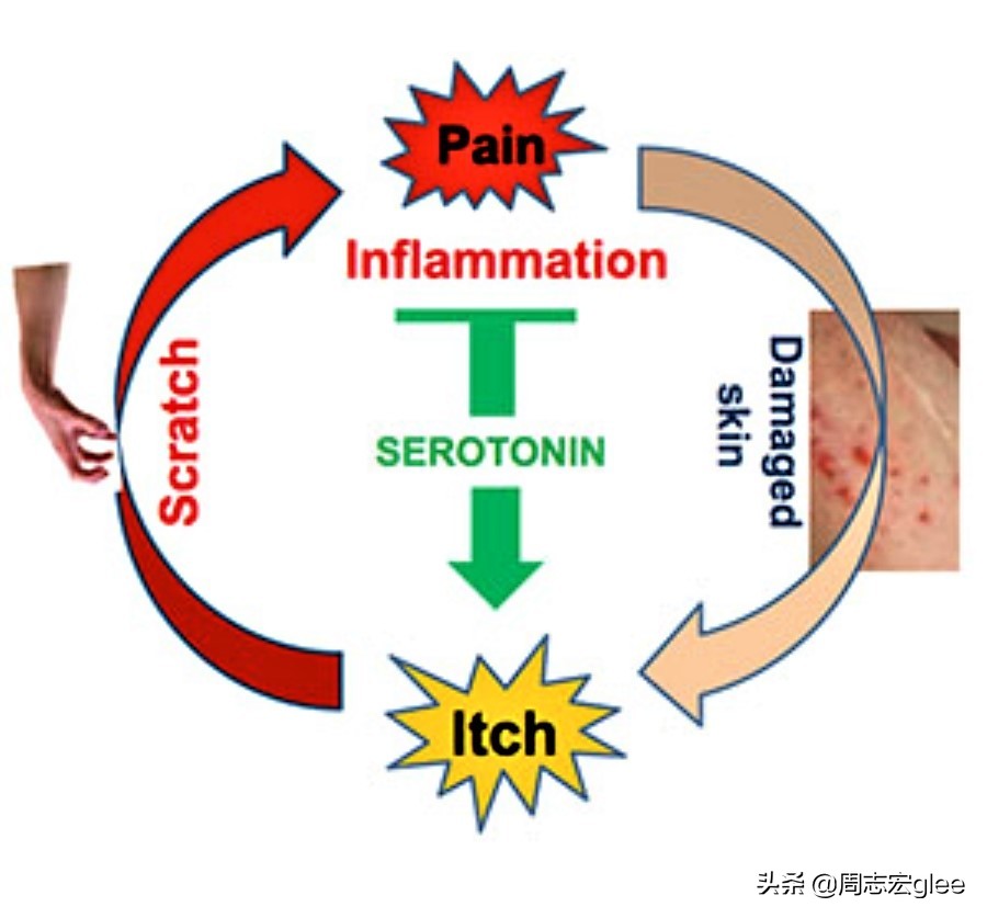 治疗蚊子咬后奇痒的药,跟蚊子咬的疙瘩一样奇痒无比