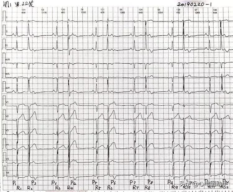 房性早搏有时伴心室内差异性传导,室性早搏伴差异性传导心电图
