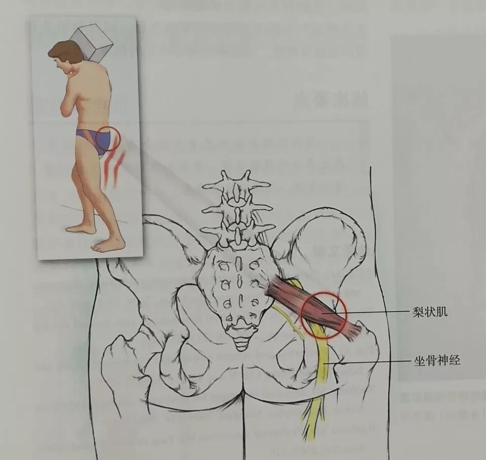 收藏综合征,男性骨盆疼痛综合征