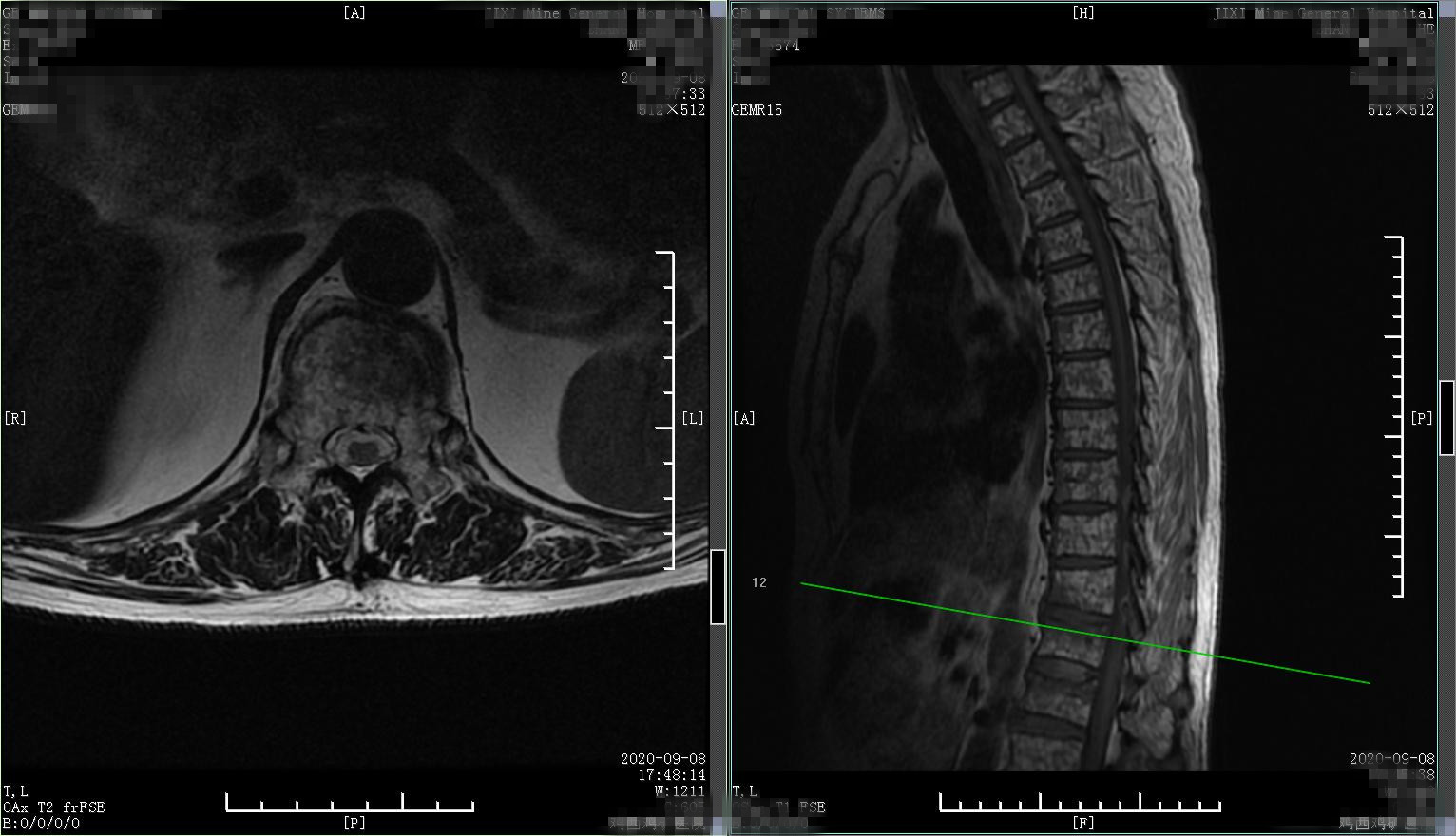 老年人腰腿痛不要忽视,中老年人腰背部酸痛
