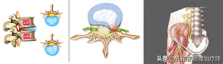 女性为什么大腿根会痛,中年女性大腿内侧疼痛是怎么回事