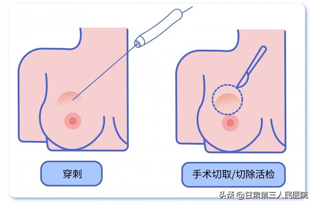 提到“乳房活检”，医生or患者在想些什么？