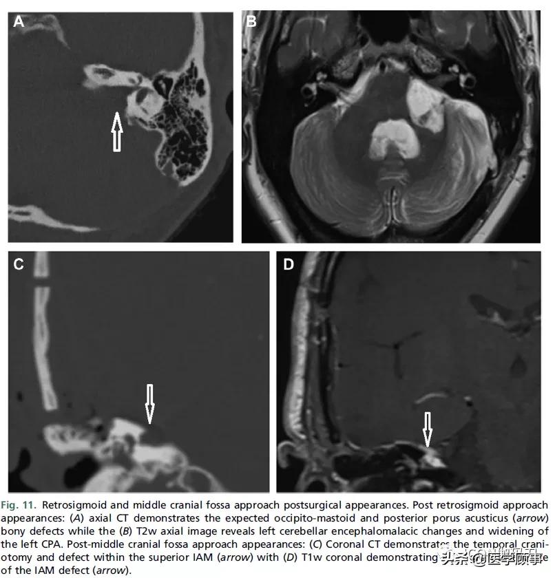 「综述」前庭神经鞘瘤的成像：诊断、监测、和治疗计划