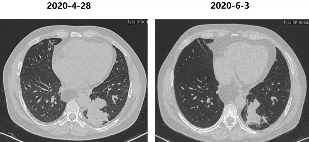 咳嗽10多天了有白痰细菌感染,咳嗽是肺部真菌感染吗