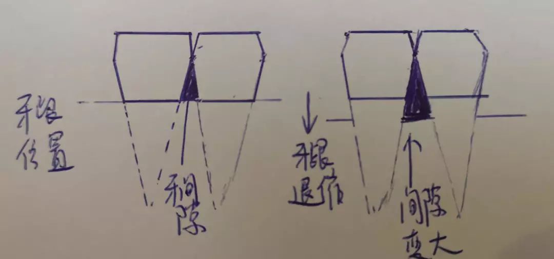 洗牙后牙缝变大了能自然恢复吗,为什么洗牙会让牙缝变大
