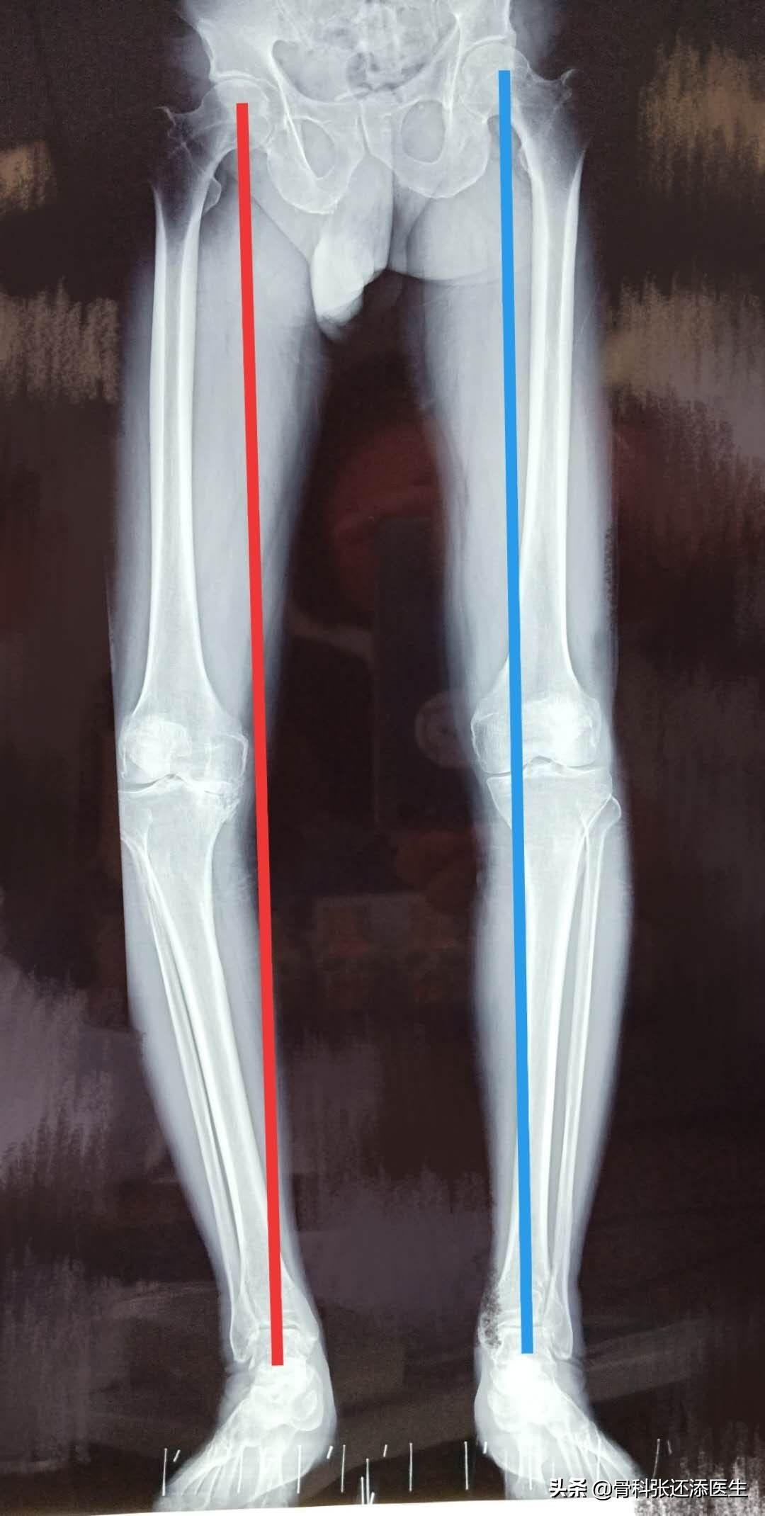 膝盖弯曲总是响是怎么回事,走路膝盖咯咯响有什么治疗方法