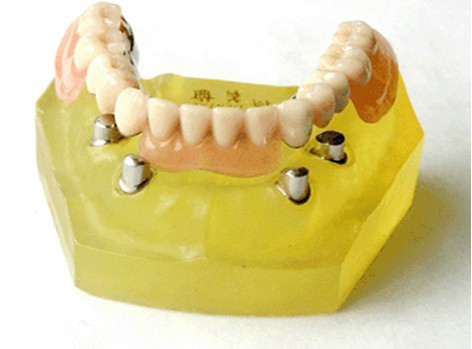 假牙价格一览表图片,假牙种类及价格表图片