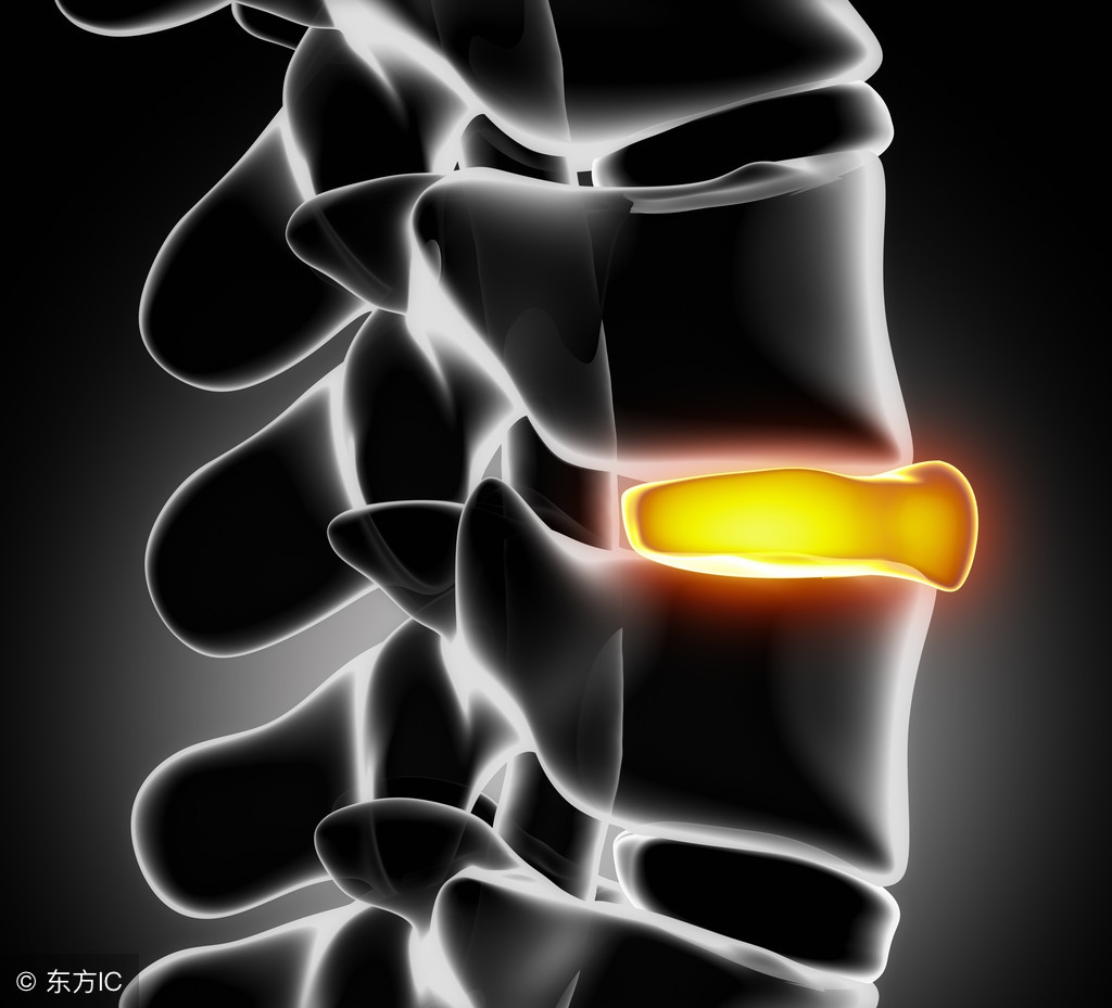 腰椎间盘突出的正确认识,腰椎间盘突出十大禁忌运动