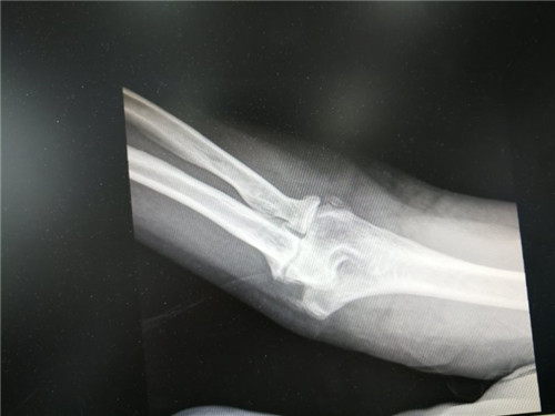 肘关节镜微创手术,潍坊肘关节镜微创手术