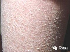 一换季皮肤就瘙痒？别挠！这样做才对