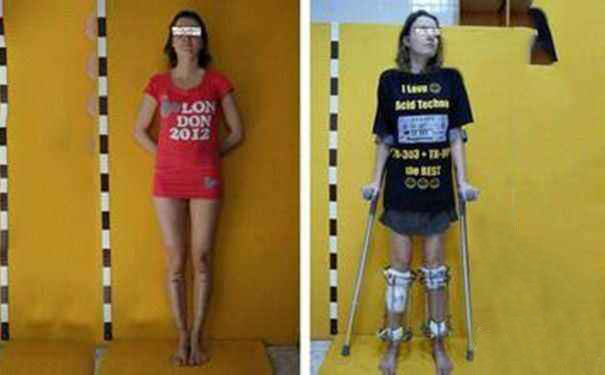 断骨增高手术成功率多少,20岁小伙做断骨增高手术