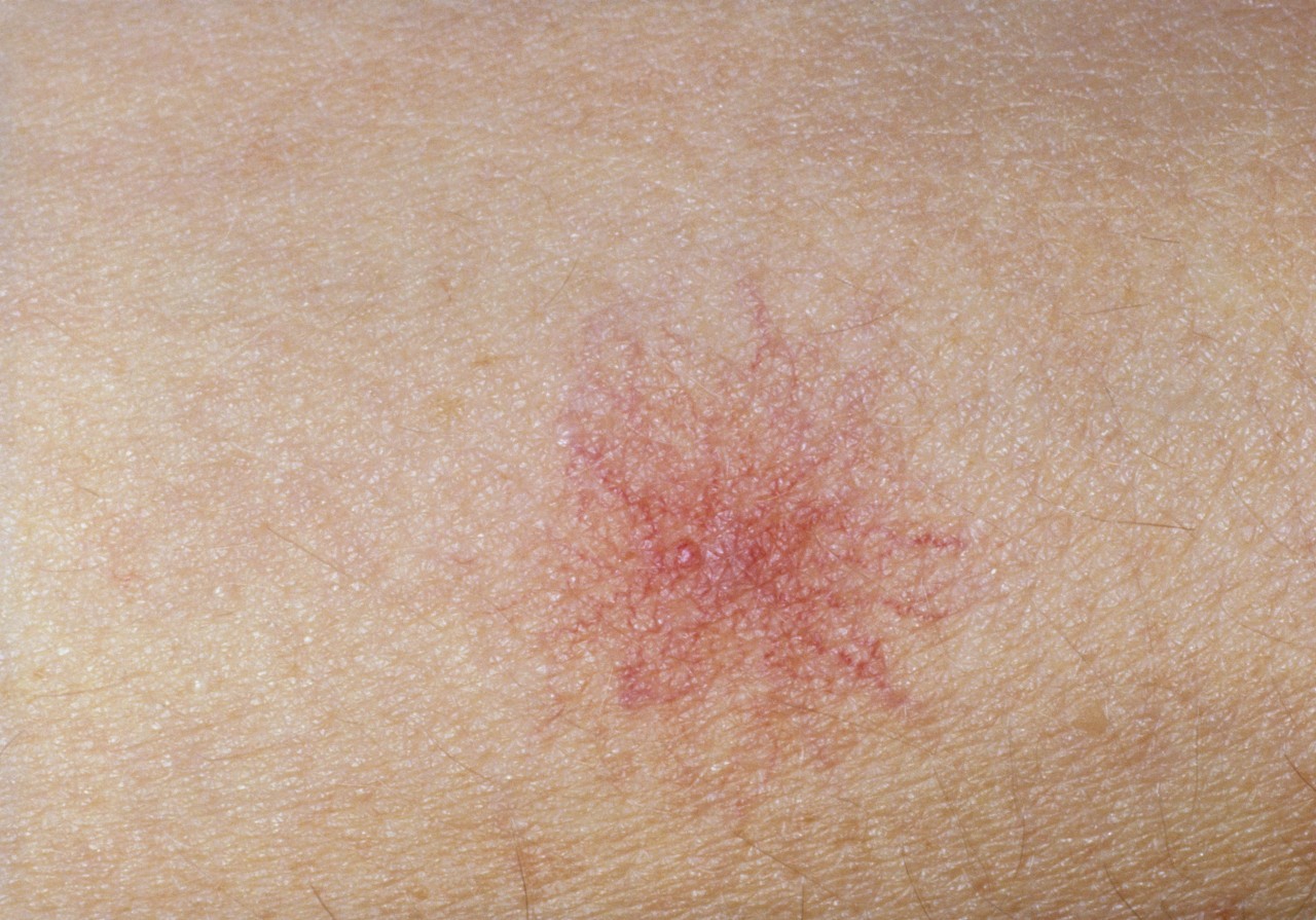 身上有两个蜘蛛痣,身上长了一颗蜘蛛痣会怎么样