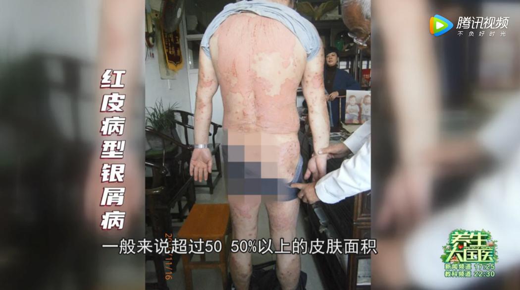 头皮发痒与体内疾病有关,头皮舌头发麻发木是什么病的前兆