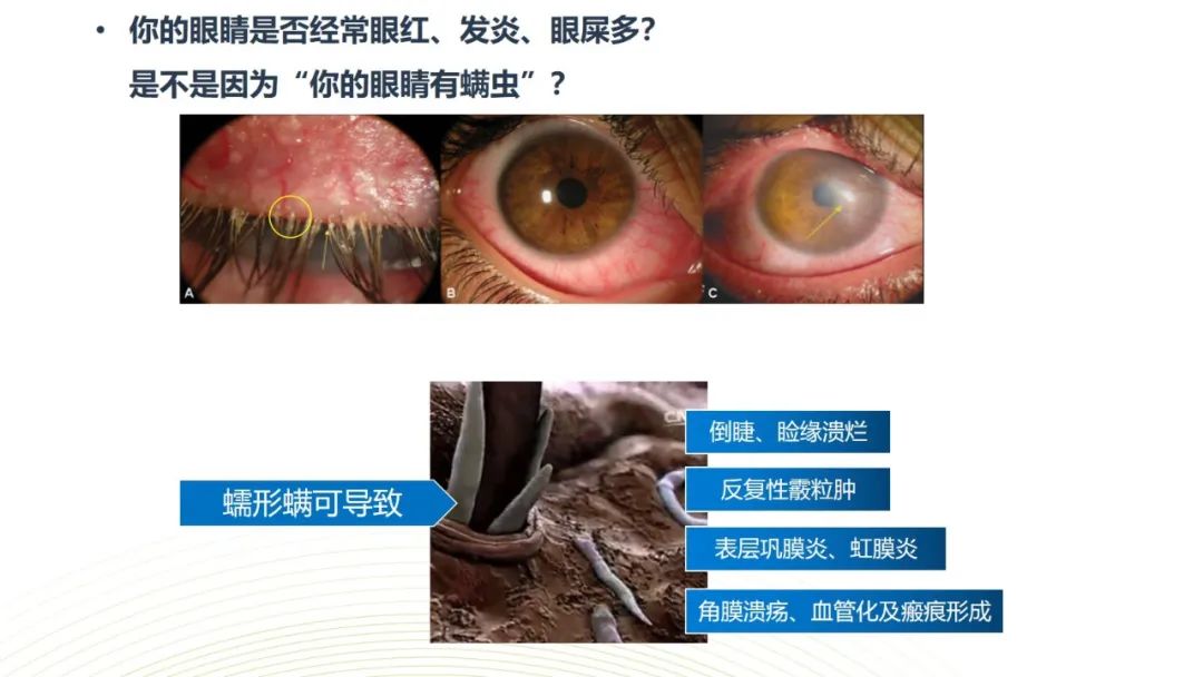 眼睛总是痒？总感觉眼睛里有东西？结膜炎角膜炎反反复复？可能是你的眼睛里有螨虫