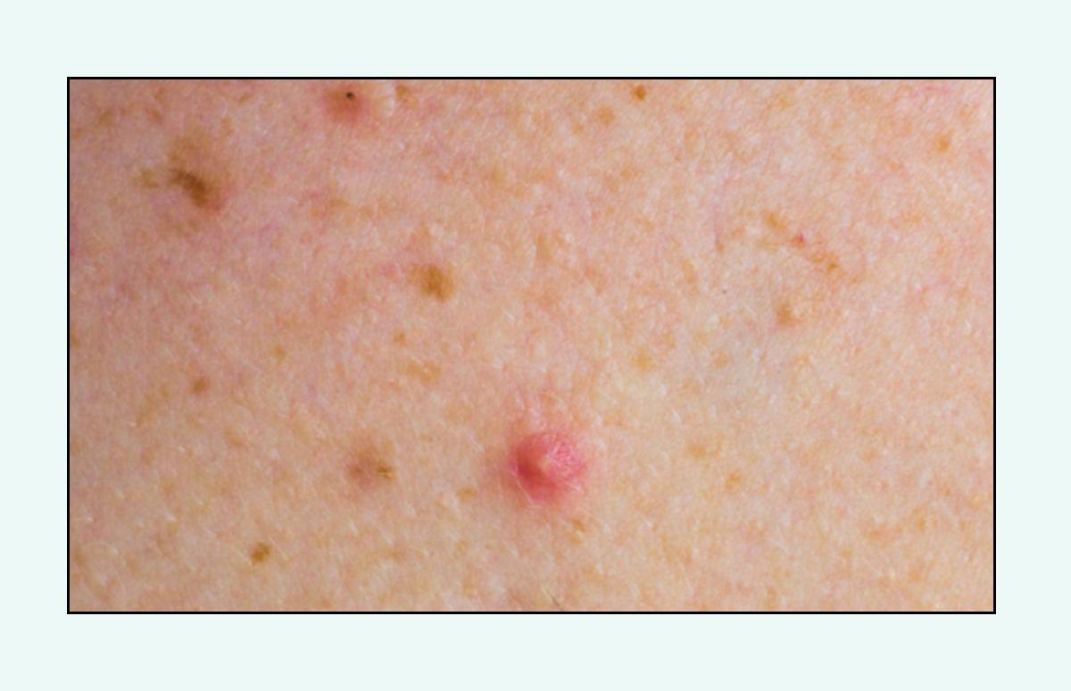 脸上的红疙瘩痒,脸上的红疙瘩用什么药膏