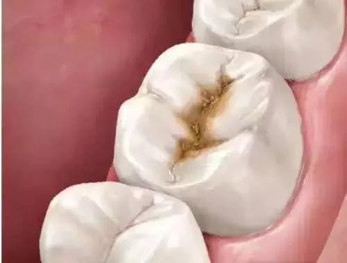 补过牙然后补的地方掉了,补过牙的地方又有蛀牙了