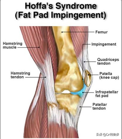 膝盖疼应该知道的几件事,膝眼痛考虑何病
