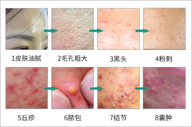 根除脸上螨虫的简单方法,螨虫在脸上如何彻底消除