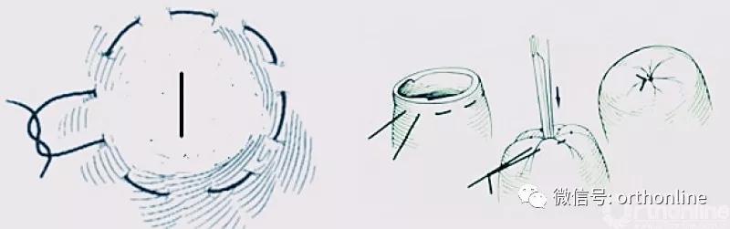 常用的手术缝合方法图,临床常见常用伤口缝合方法