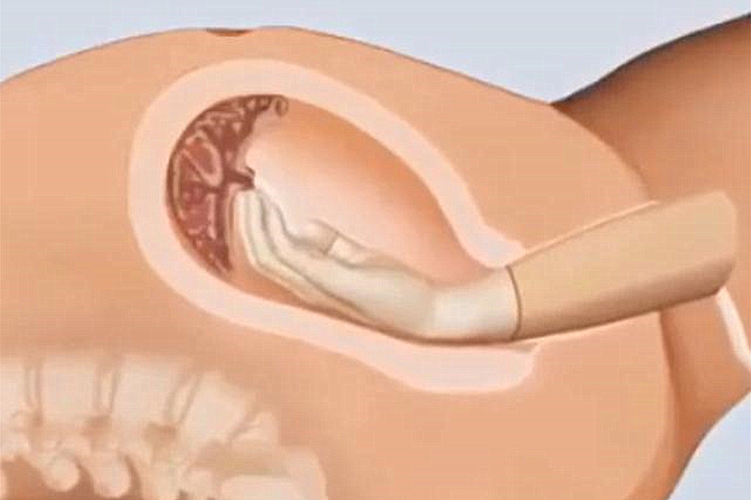 生完孩子医生又把手伸进去，产妇愤怒质问，医生沉稳回答：为你好