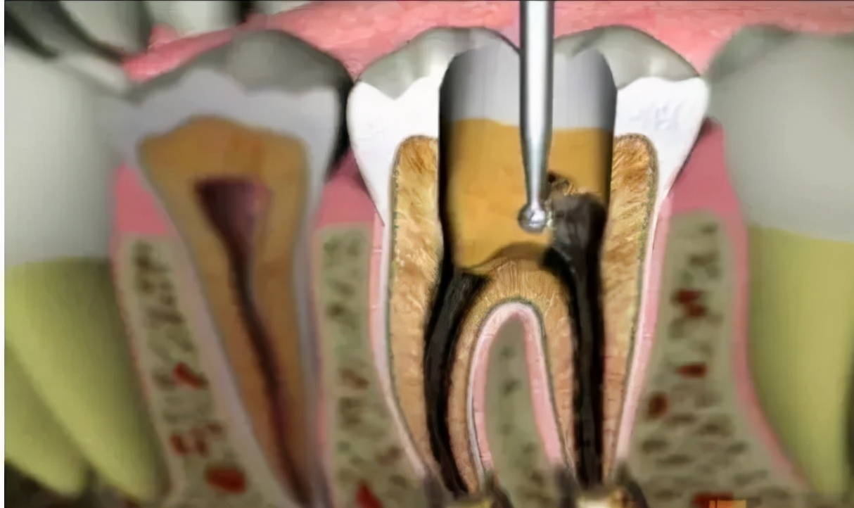 牙齿的普通治疗与根管治疗,根管治疗最严重的牙齿