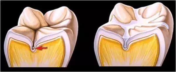 预防儿童蛀牙可打针预防吗,预防蛀牙可做窝沟封闭