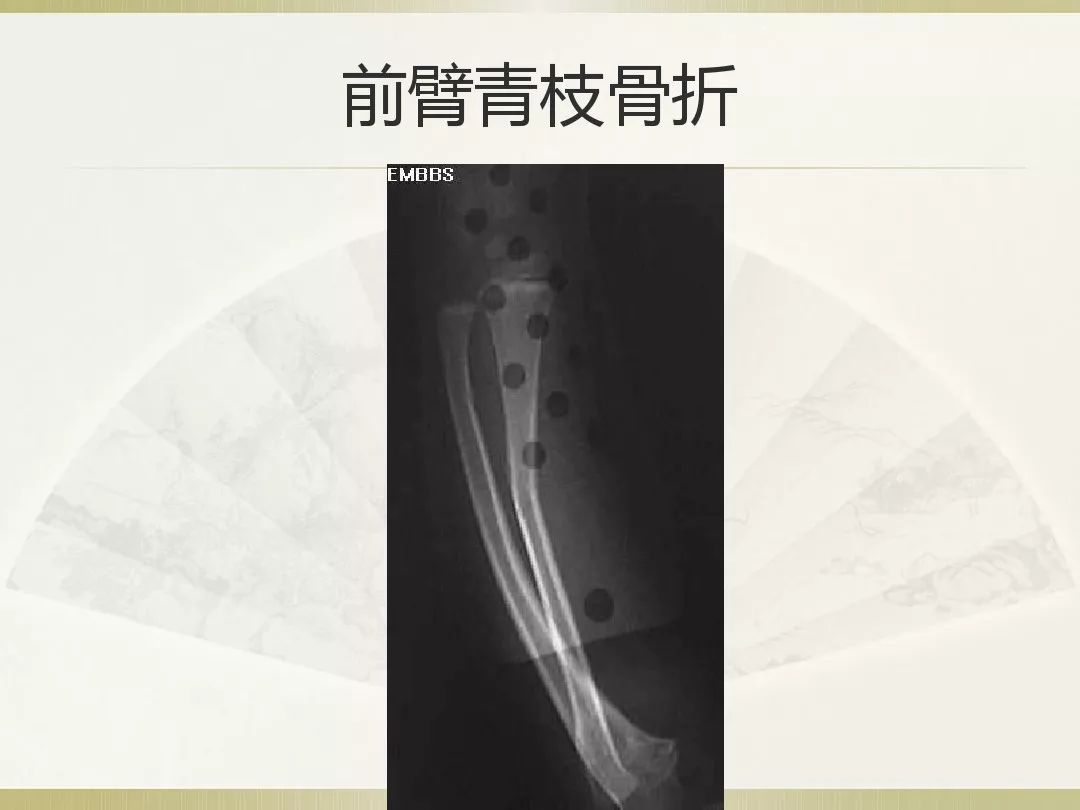 骨科x光片读片技巧,放射科骨科读片教程