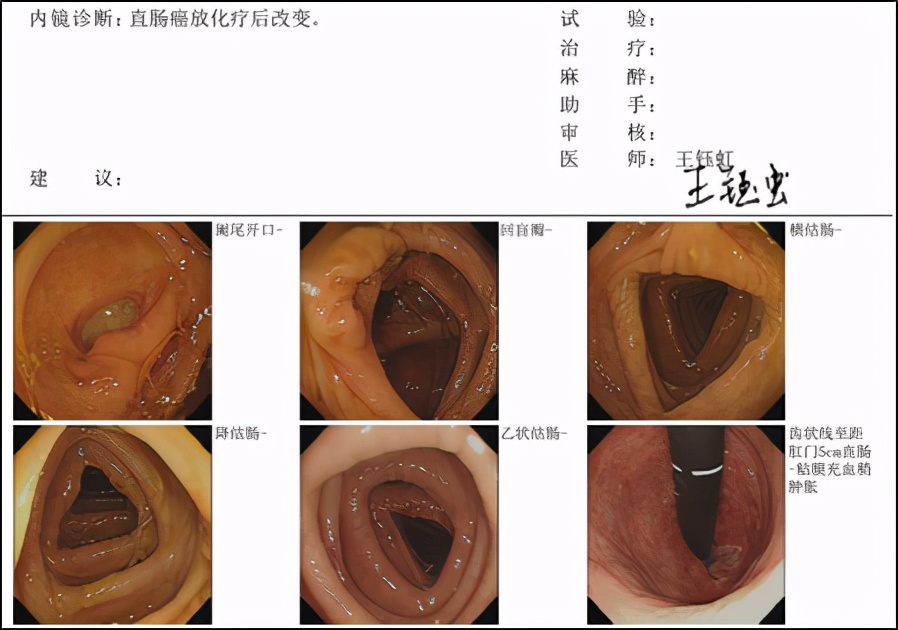 低位直肠癌保肛手术不造瘘利弊,低位直肠癌保肛会影响复发率么