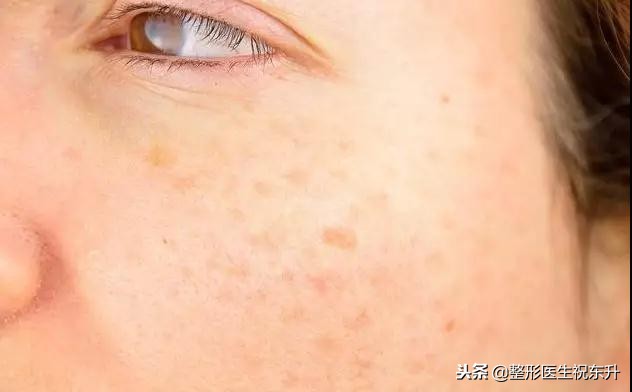 激光祛斑后反黑可以用生长因子吗,激光祛斑后反黑可以涂维生素e吗