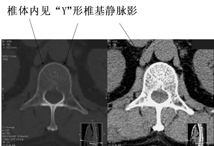 颈椎腰椎疾病ct及mri诊断,腰椎ct可以发现肠部病变吗