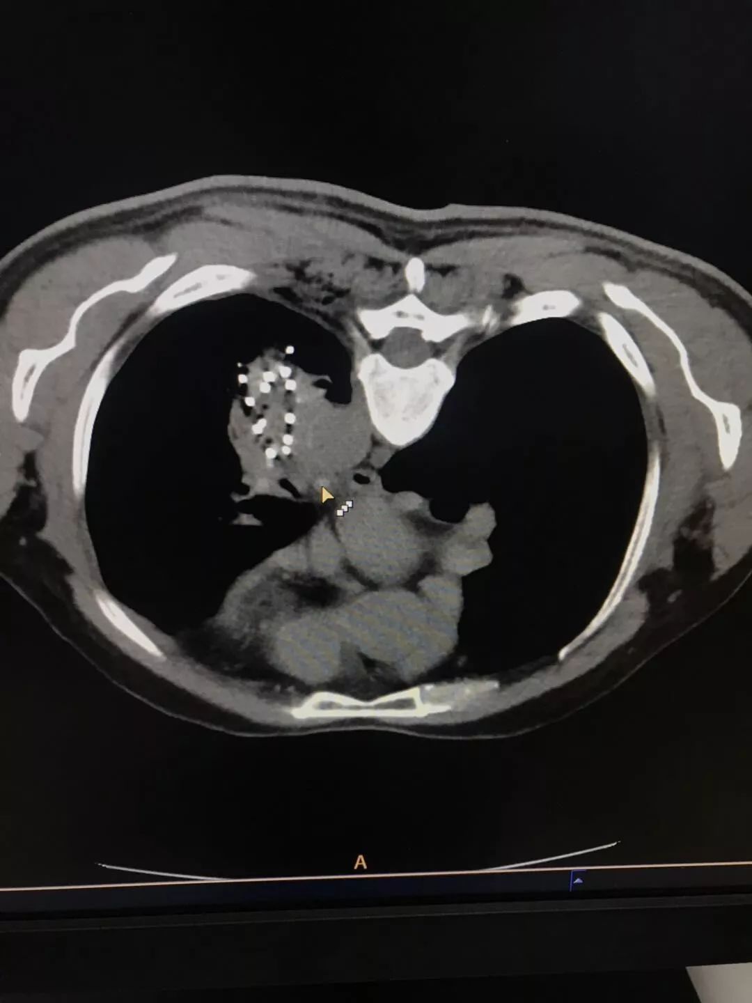 晚期肺癌患者,应用粒子植入术,抗癌案例分享