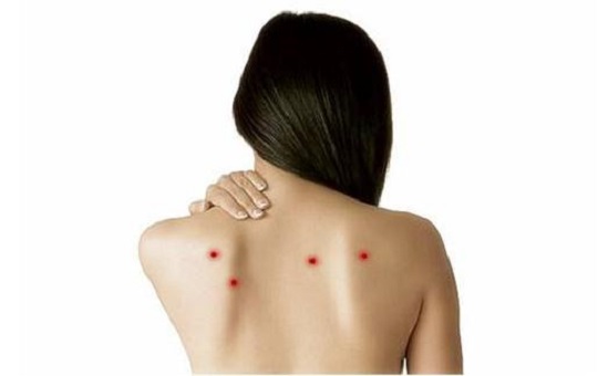 祛痘后开始爆痘原因有哪些,易长痘怎么祛痘痘小妙招