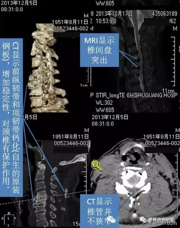 颈椎病治疗的十大误区,颈椎病4大治疗误区你知道吗
