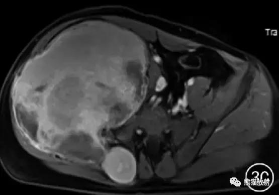 假性血友病什么症状,血友病病理