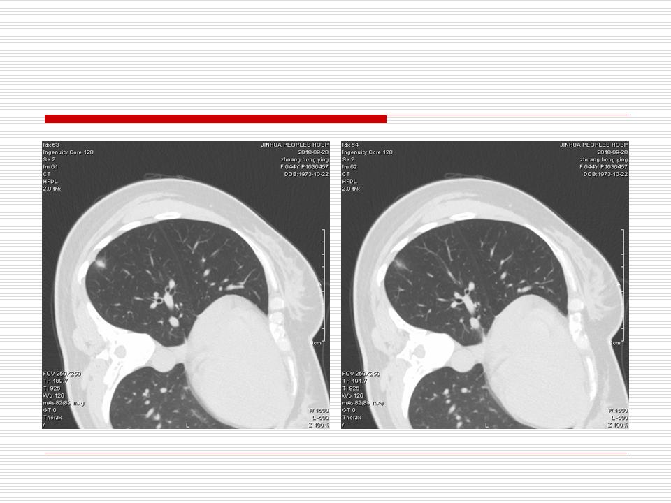 像炎症的肺癌能治好吗,医生说可能是肺癌也可能是炎症