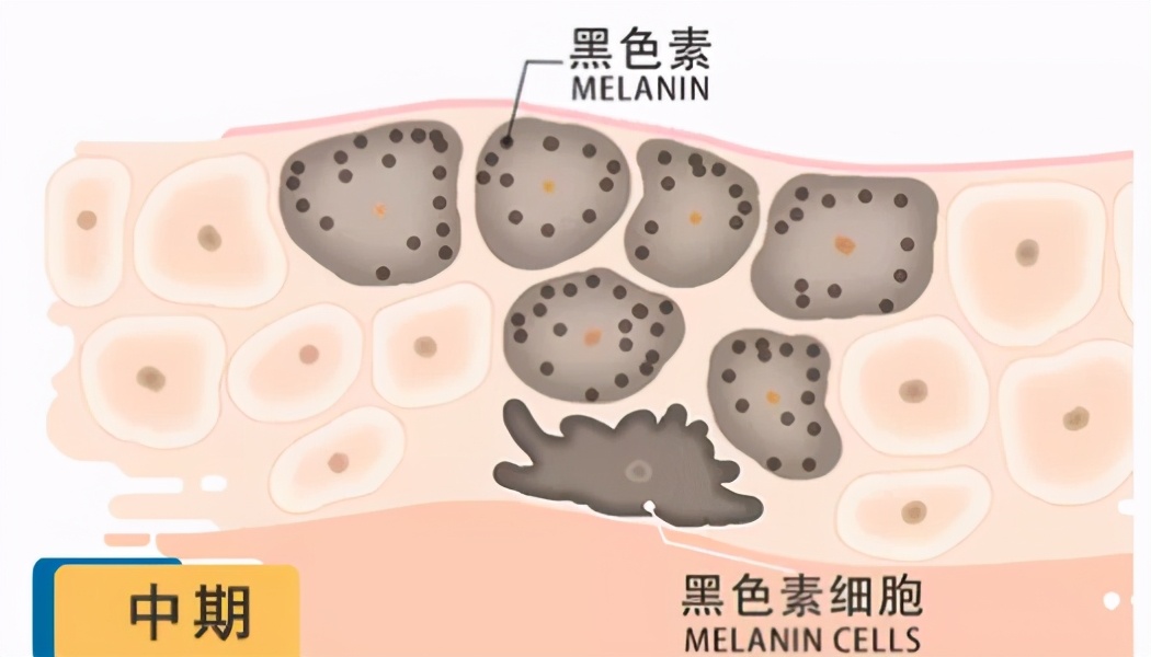 青褐斑激光治疗后颜色会加深吗,激光可以淡化褐斑吗