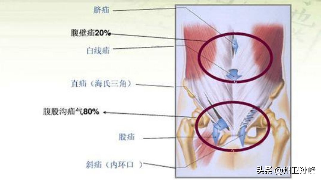 勿以疝小而不为疝气,如何判断腹股沟疝的严重程度