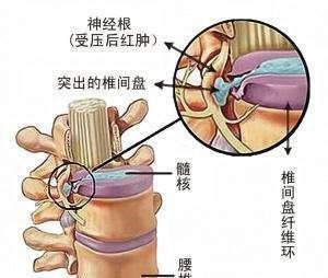 腰突引起的腿疼屁股疼怎么治疗,百年扁氏老黑膏治疗腰突有效吗
