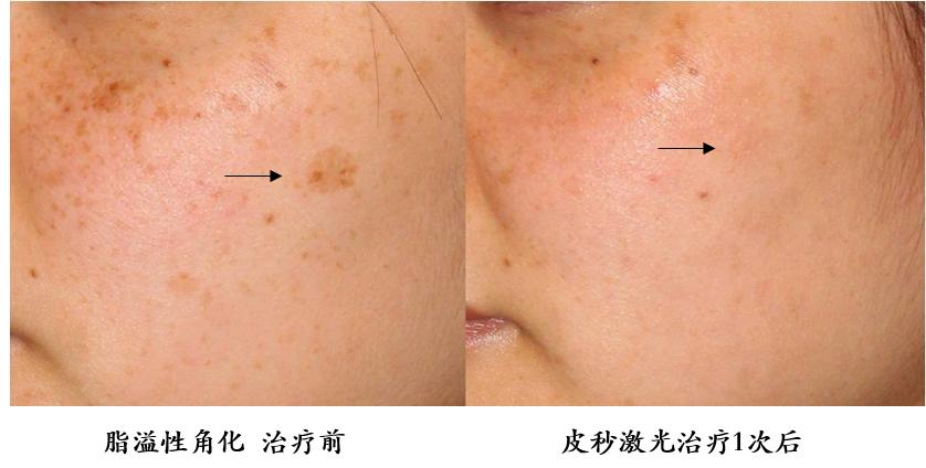 皮秒激光祛斑能保护表皮不受损伤,超皮秒激光祛斑的危害与效果视频