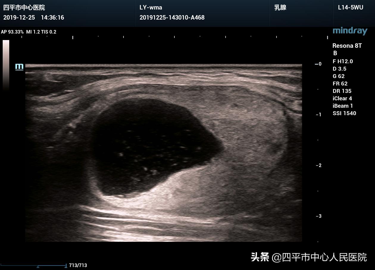 超声引导下甲状腺结节微波消融术,甲状腺结节微波消融术哪有做的