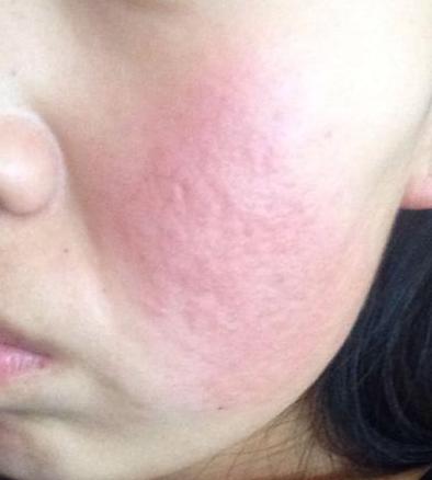 100人里就有20人中招，清洁不到位导致脸上冒虫，毛孔需要早清洁