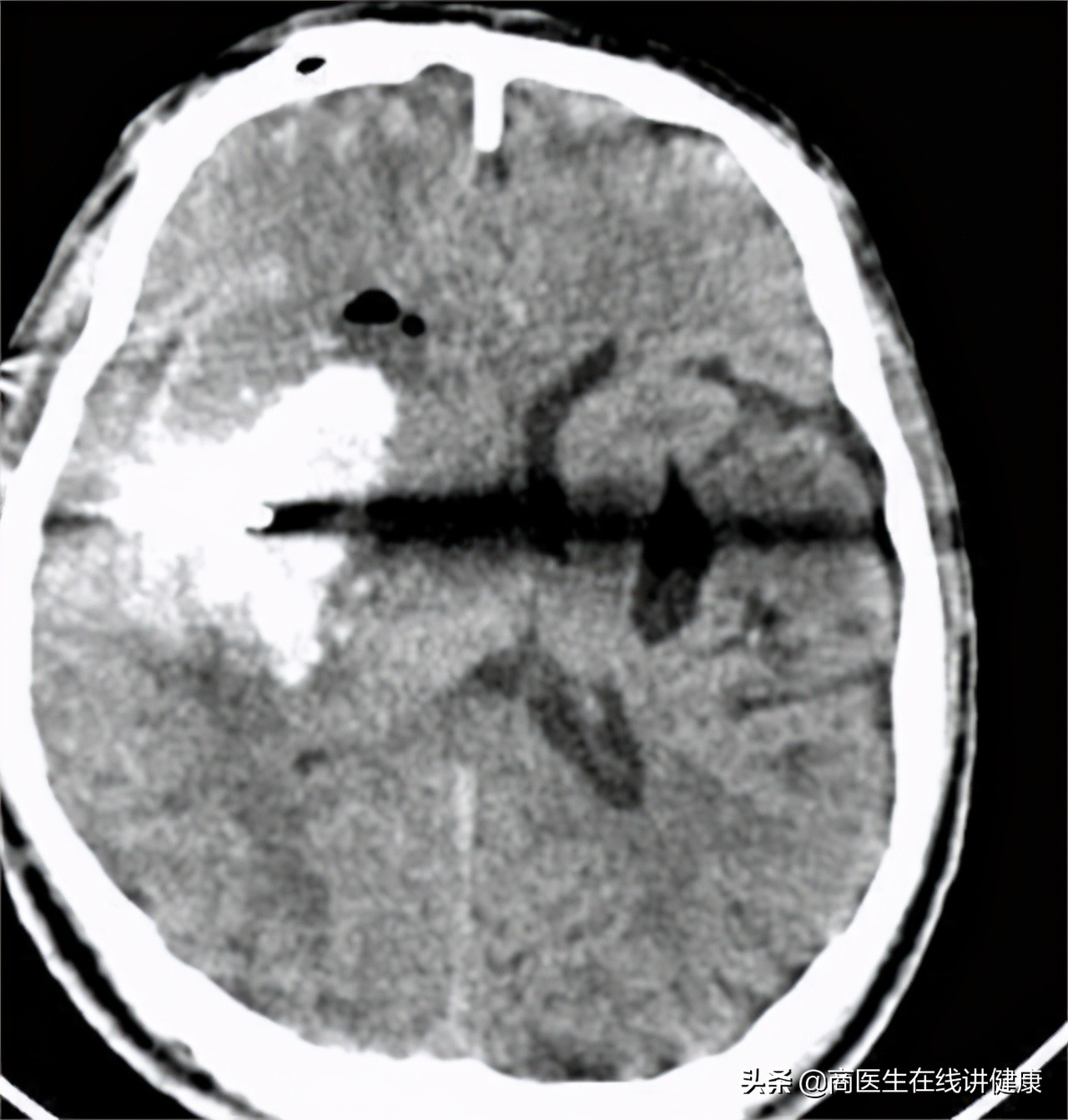 高血压吃降压药需要补充叶酸吗,高血压患者如何补充叶酸