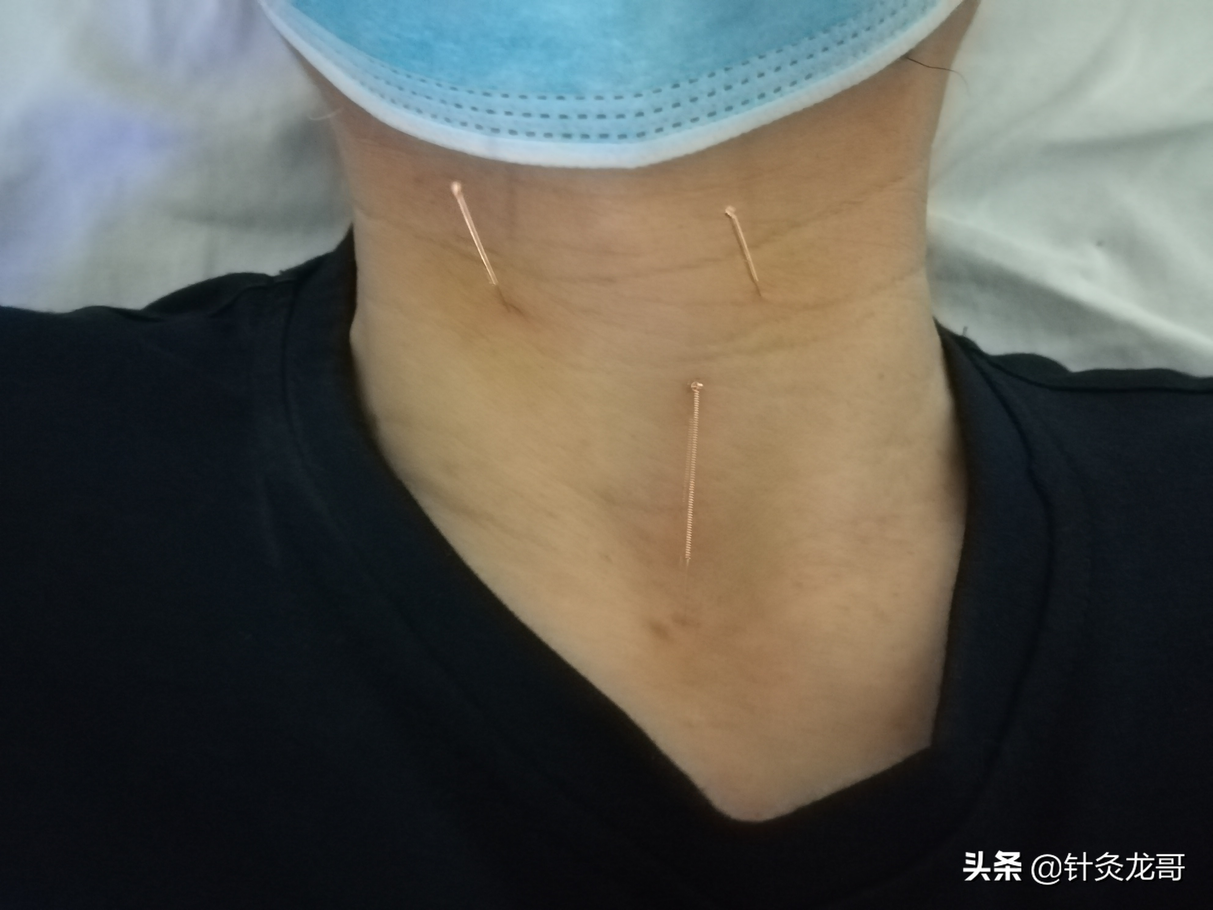 咽喉有异物怎么检查一下,咽喉有异物感好几个月了