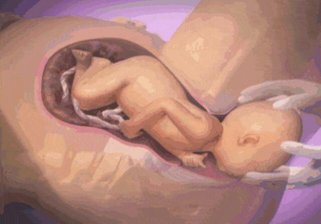 无痛分娩，带给产妇福音的一种分娩方式，您了解吗