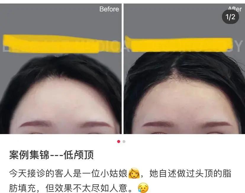 小腿阻断针,小腿阻断